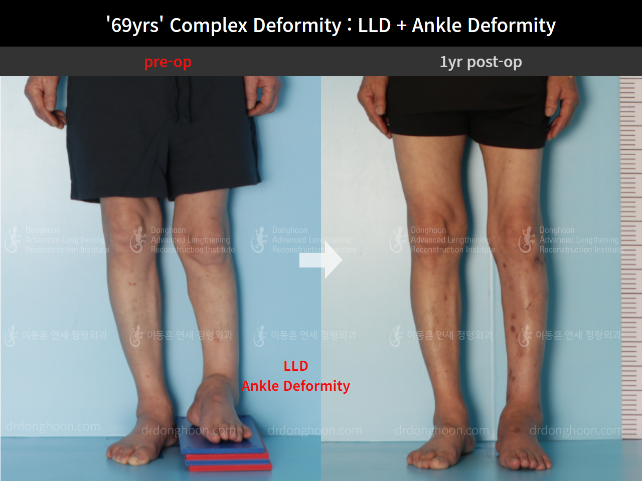 Before and after complex deformity, case 8981701, image 3, Dr. Donghoon institute (DALRI)