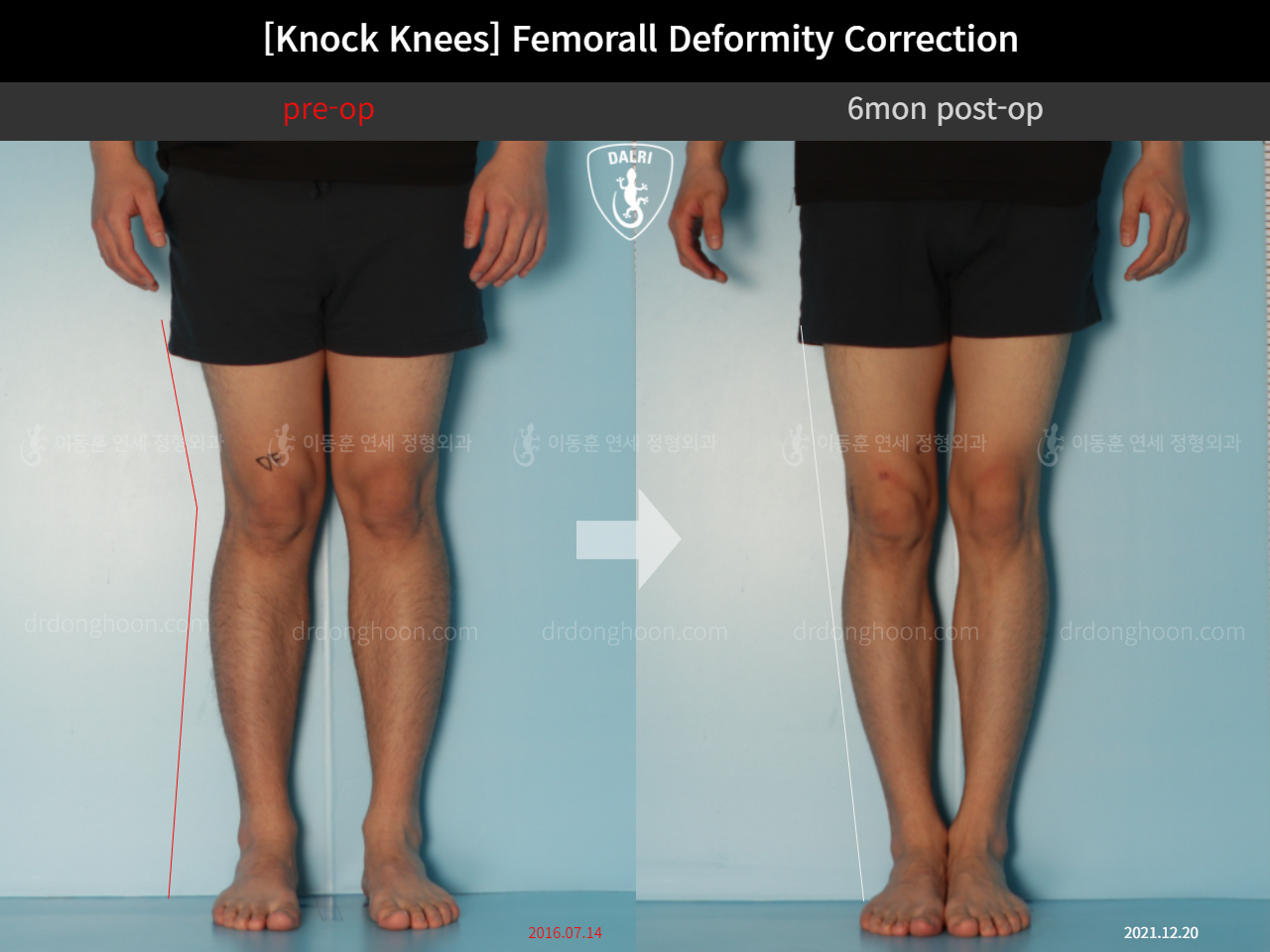 Before and after adult knock knees, case 11773301, image 3, Dr. Donghoon institute (DALRI)