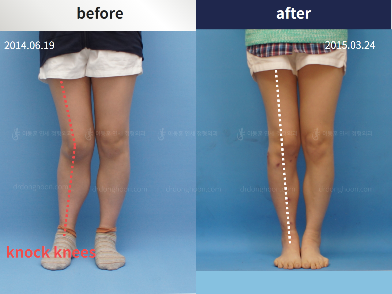 Before and after complex deformity, case 4251572, image 1, Dr. Donghoon institute (DALRI)