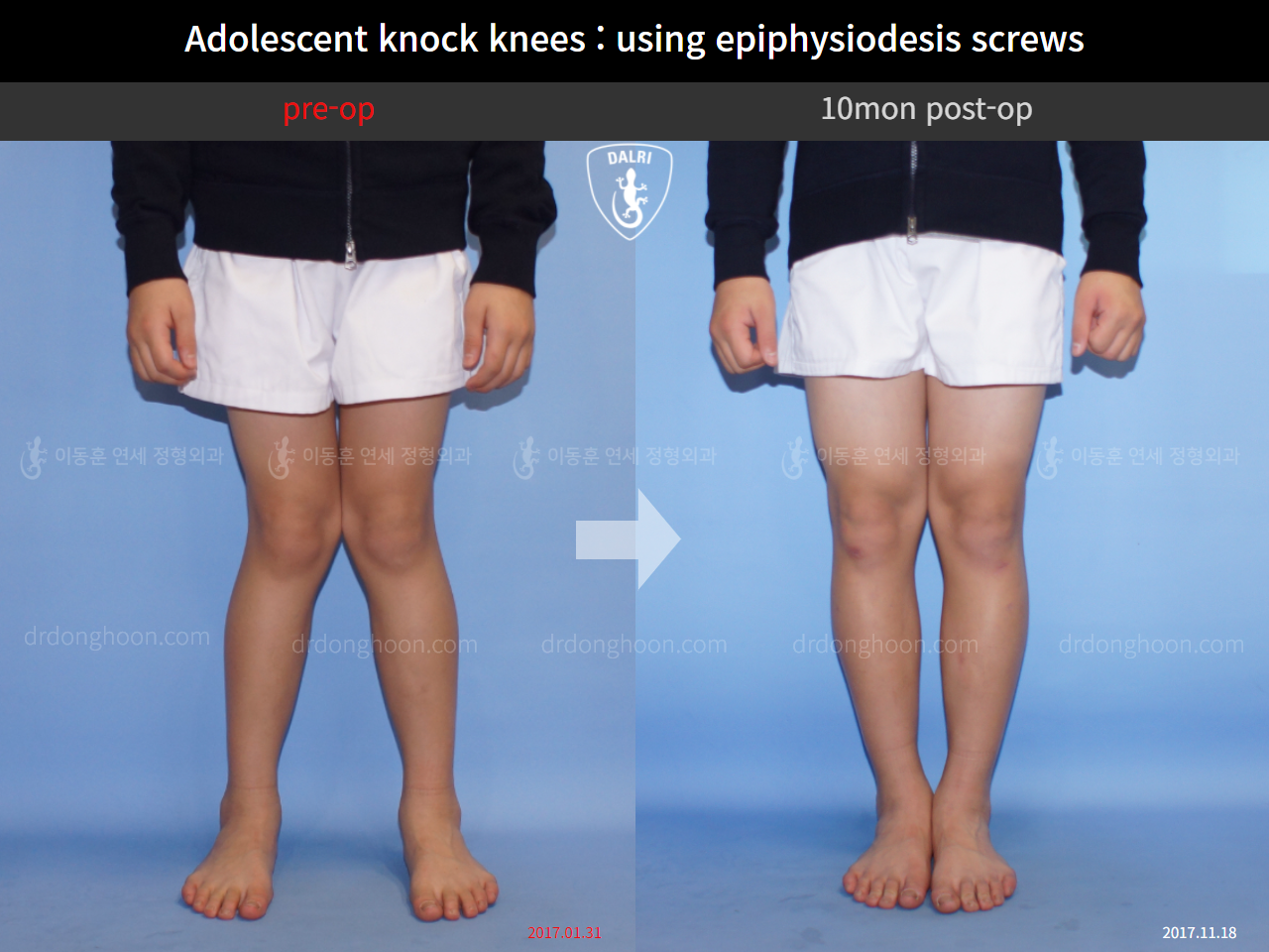 Before and after paediatric & adolescent knock knees, case 4310936, image 3, Dr. Donghoon institute (DALRI)