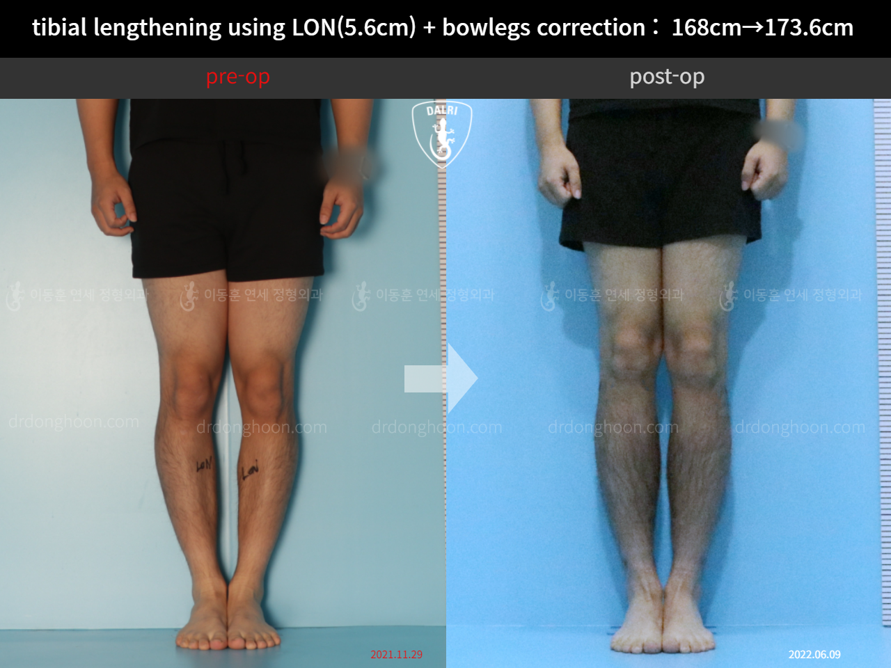 Before and after cll + deformity correction, case 11802994, image 5, Dr. Donghoon institute (DALRI)