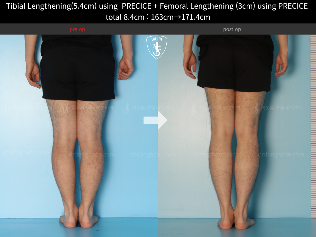 Before and after cll precice, case 12051302, image 8, Dr. Donghoon institute (DALRI)