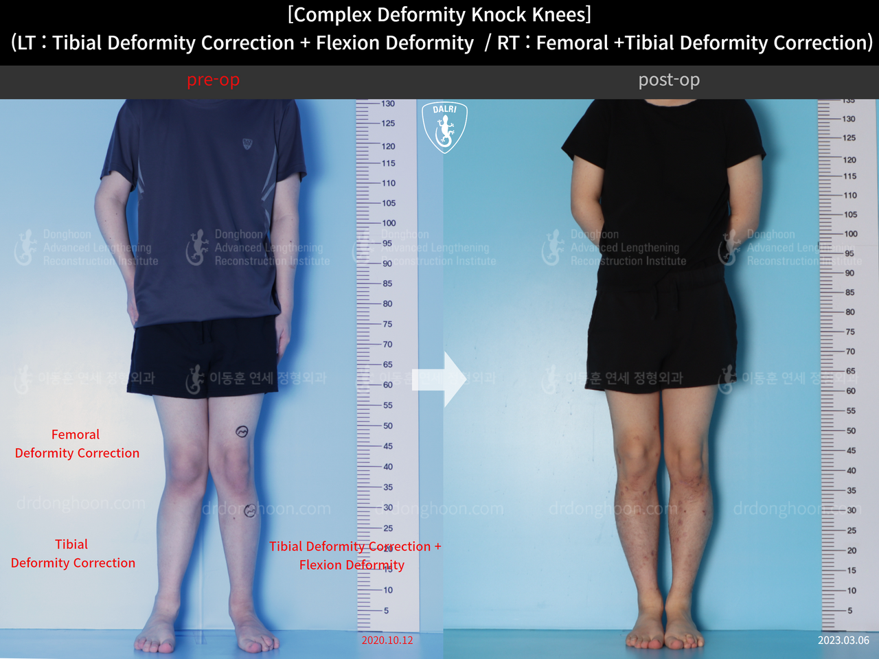 Before and after adult knock knees, case 14439339, image 3, Dr. Donghoon institute (DALRI)