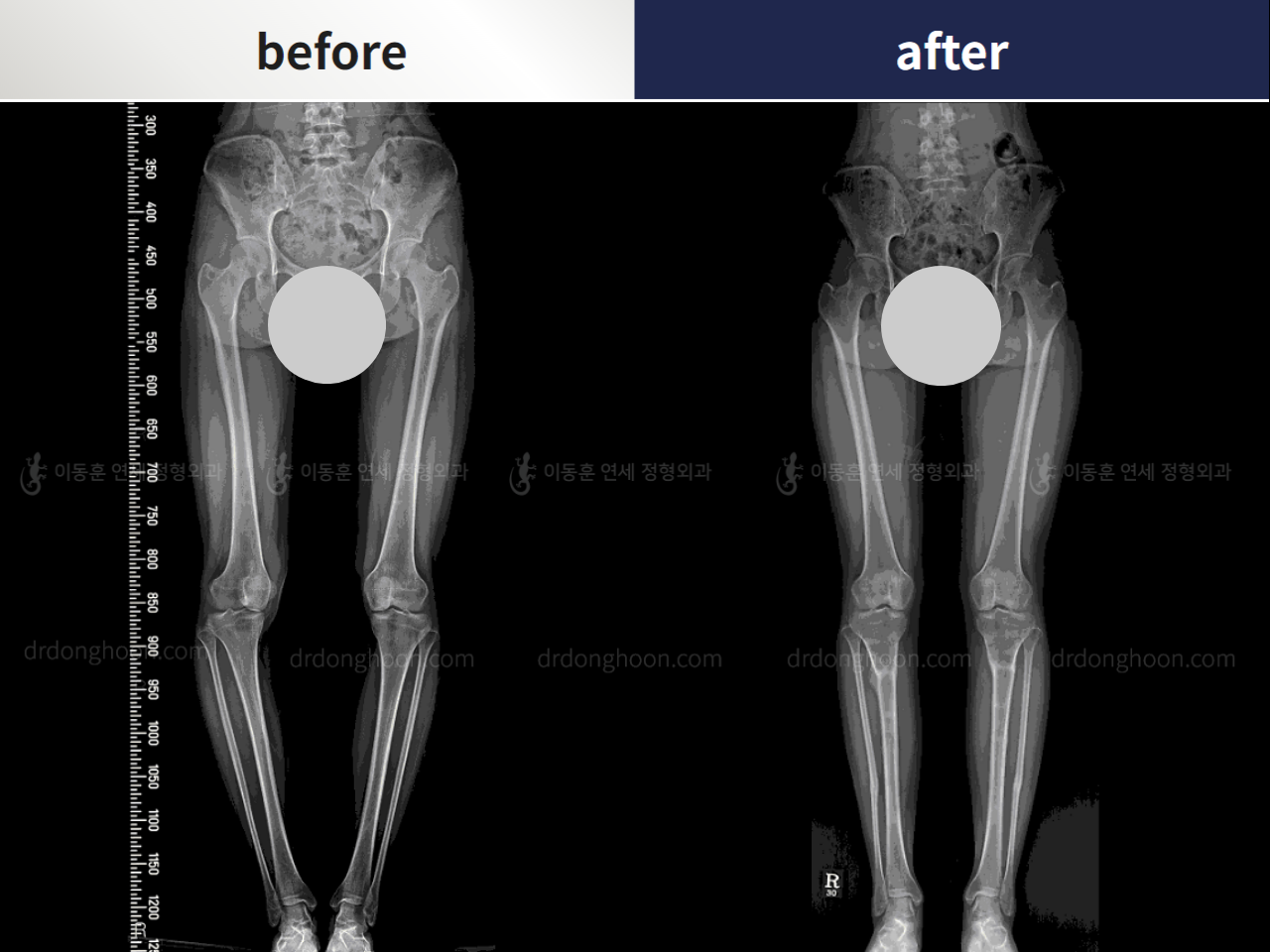 Before and after complex deformity, case 4297344, image 2, Dr. Donghoon institute (DALRI)