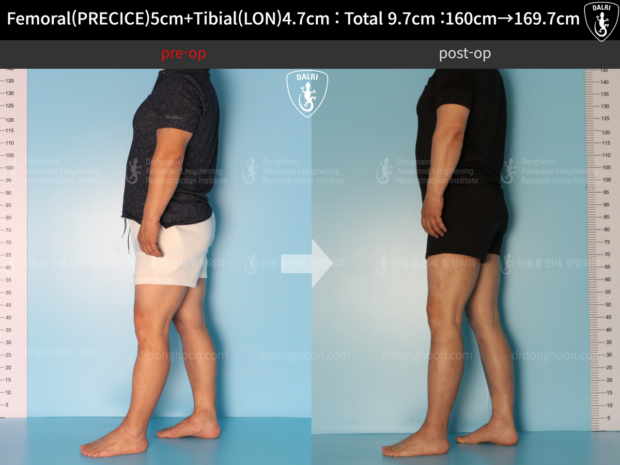 Before and after cll precice, case 7755066, image 6, Dr. Donghoon institute (DALRI)