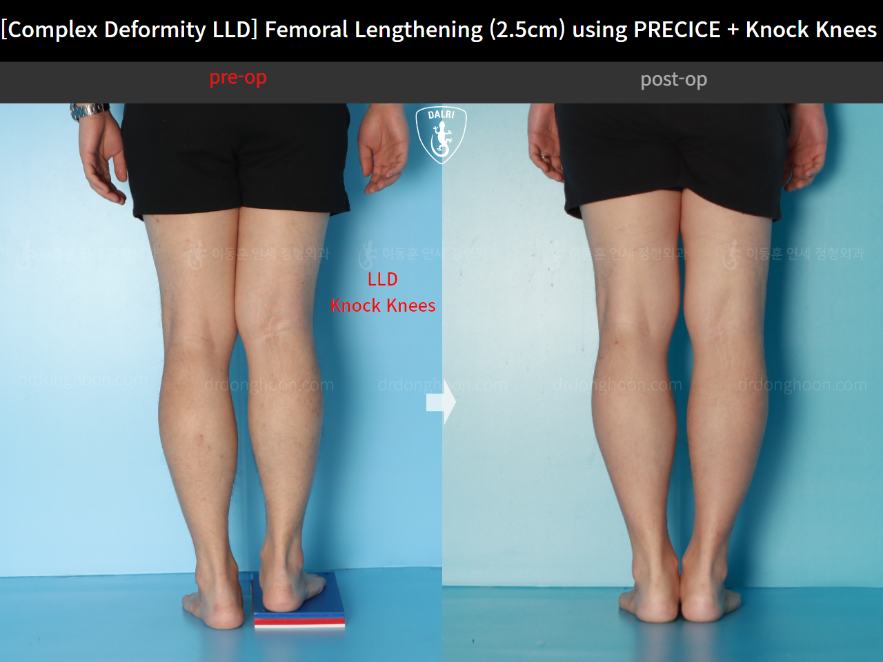 Before and after adult lld, case 17589131, image 6, Dr. Donghoon institute (DALRI)