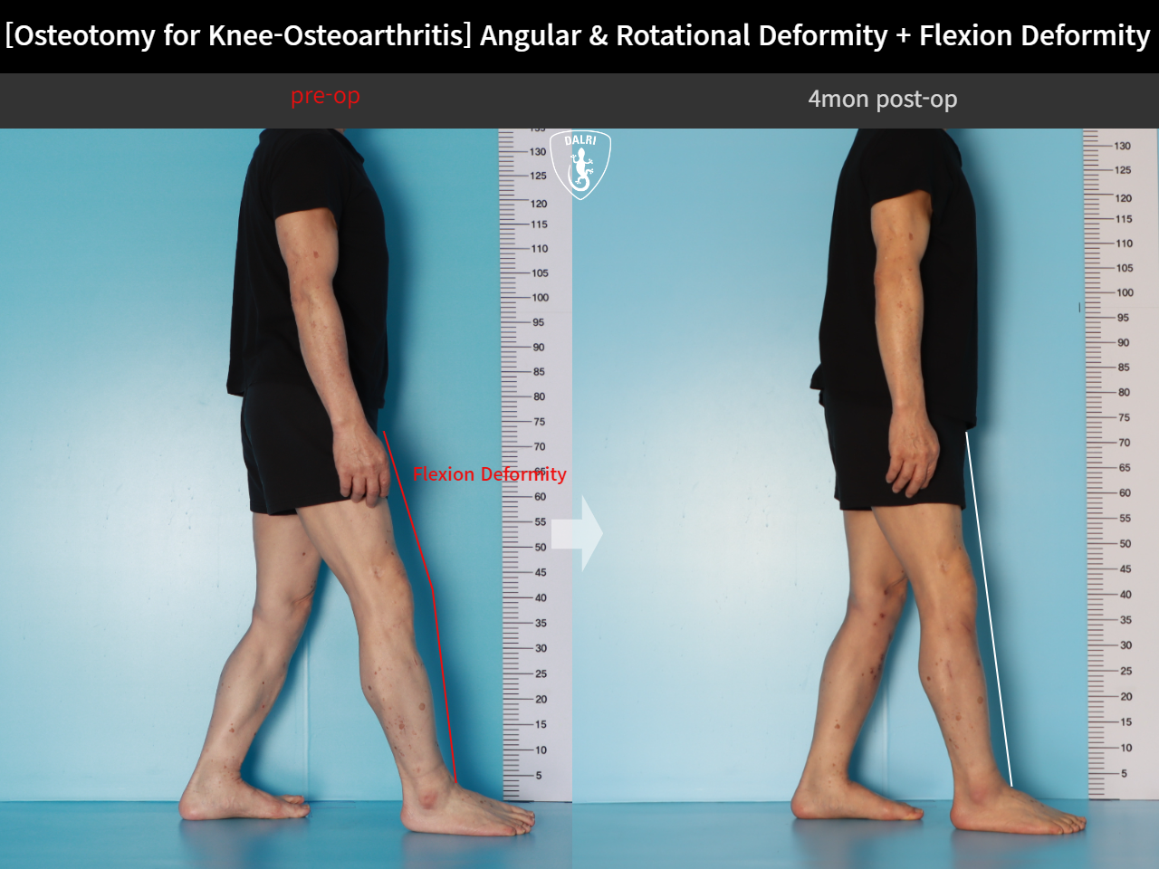Before and after osteotomy for knee osteoarthritis, case 18162350, image 6, Dr. Donghoon institute (DALRI)