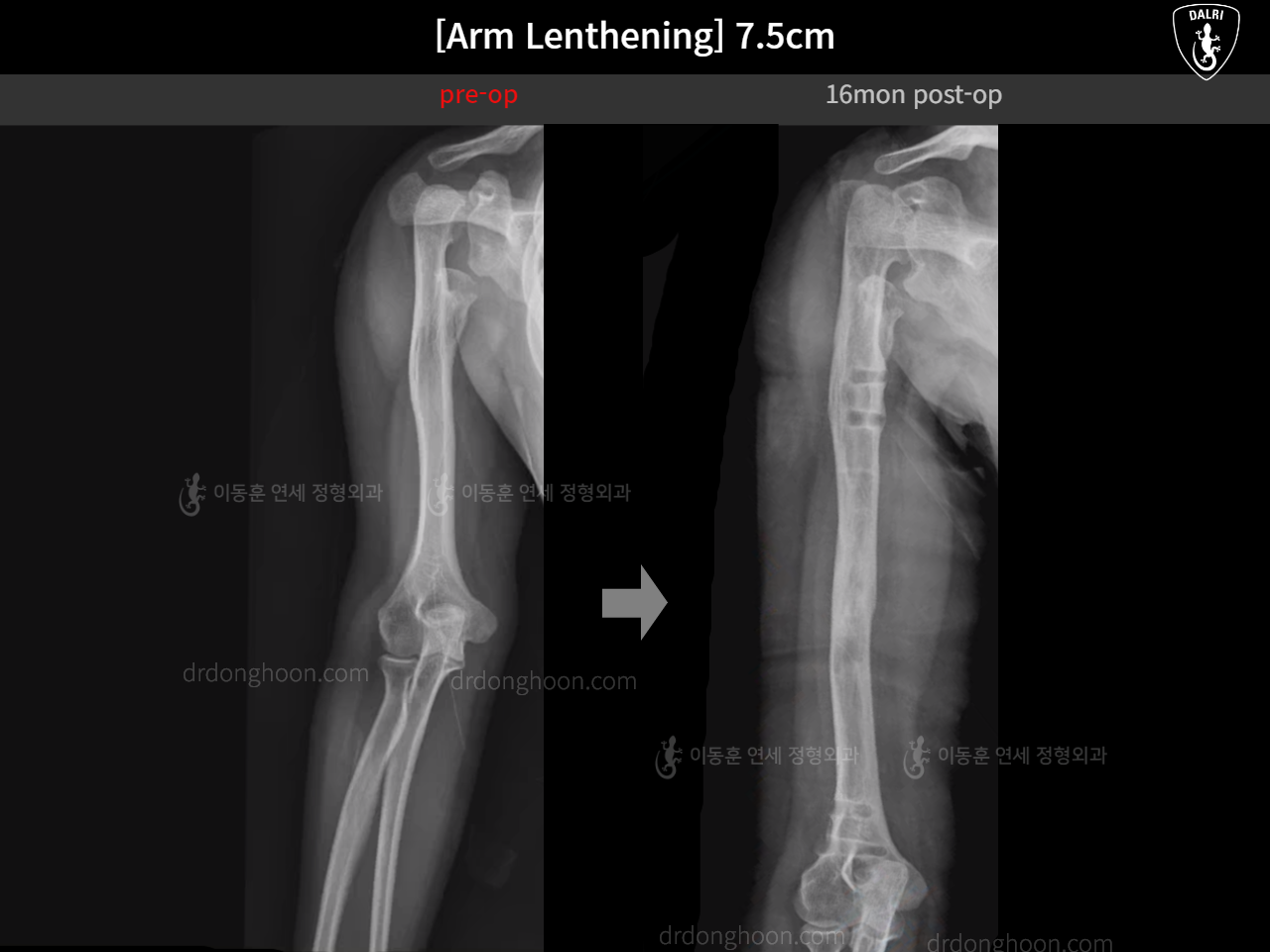 Before and after arm lengthening, case 16280690, image 1, Dr. Donghoon institute (DALRI)