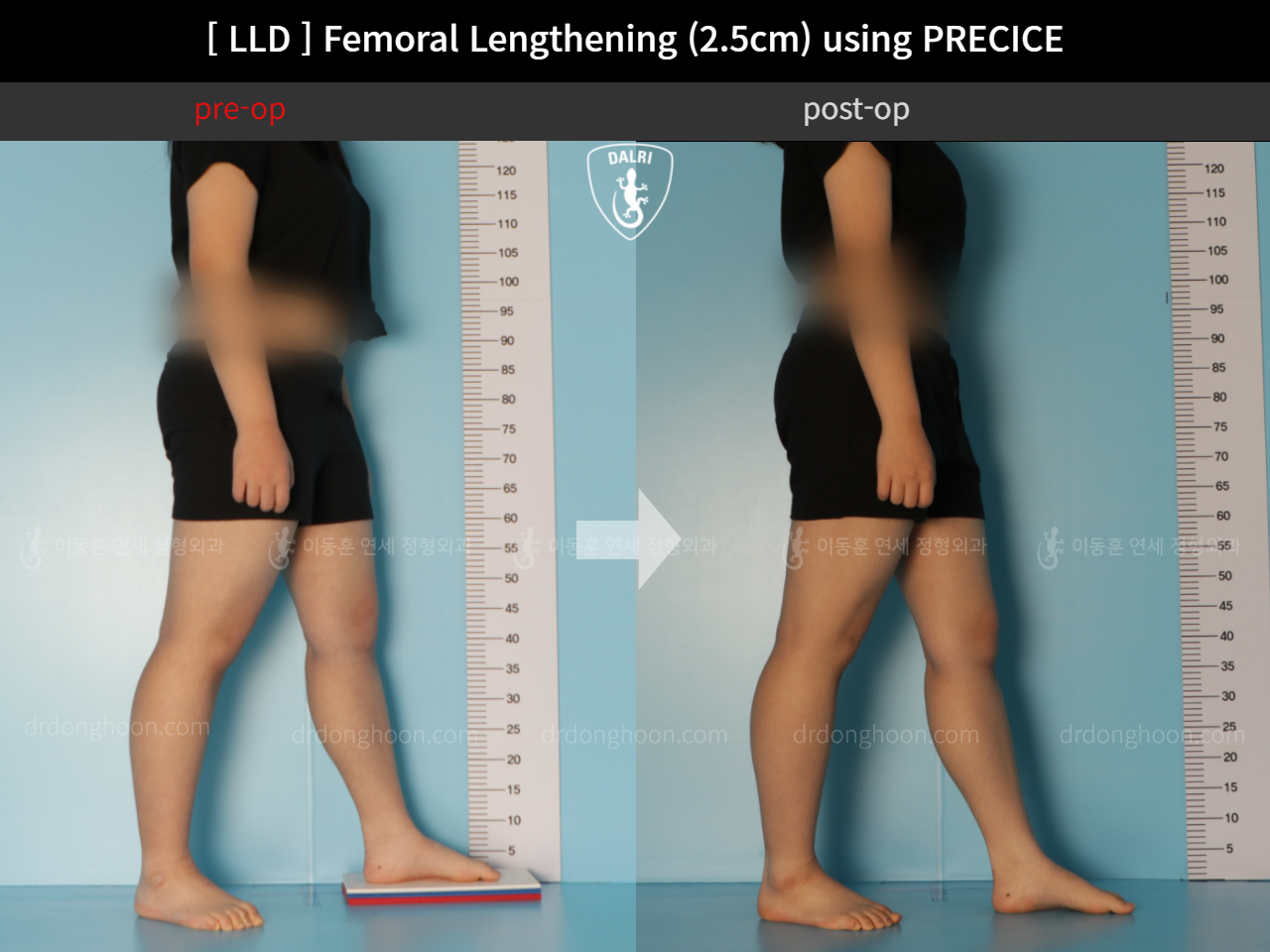 Before and after adult lld, case 11367647, image 4, Dr. Donghoon institute (DALRI)
