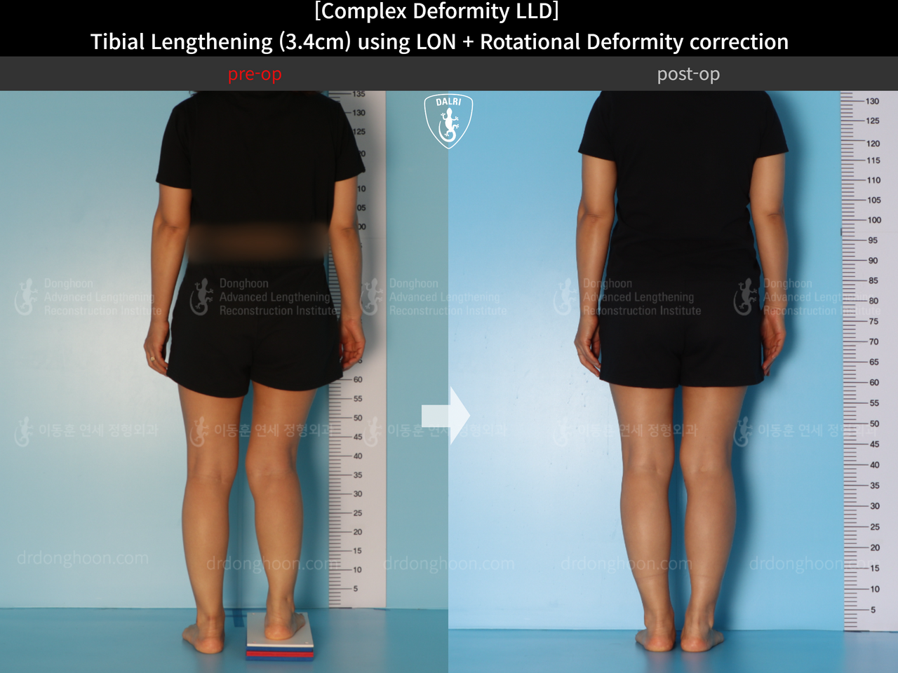 Before and after adult lld, case 14350311, image 5, Dr. Donghoon institute (DALRI)