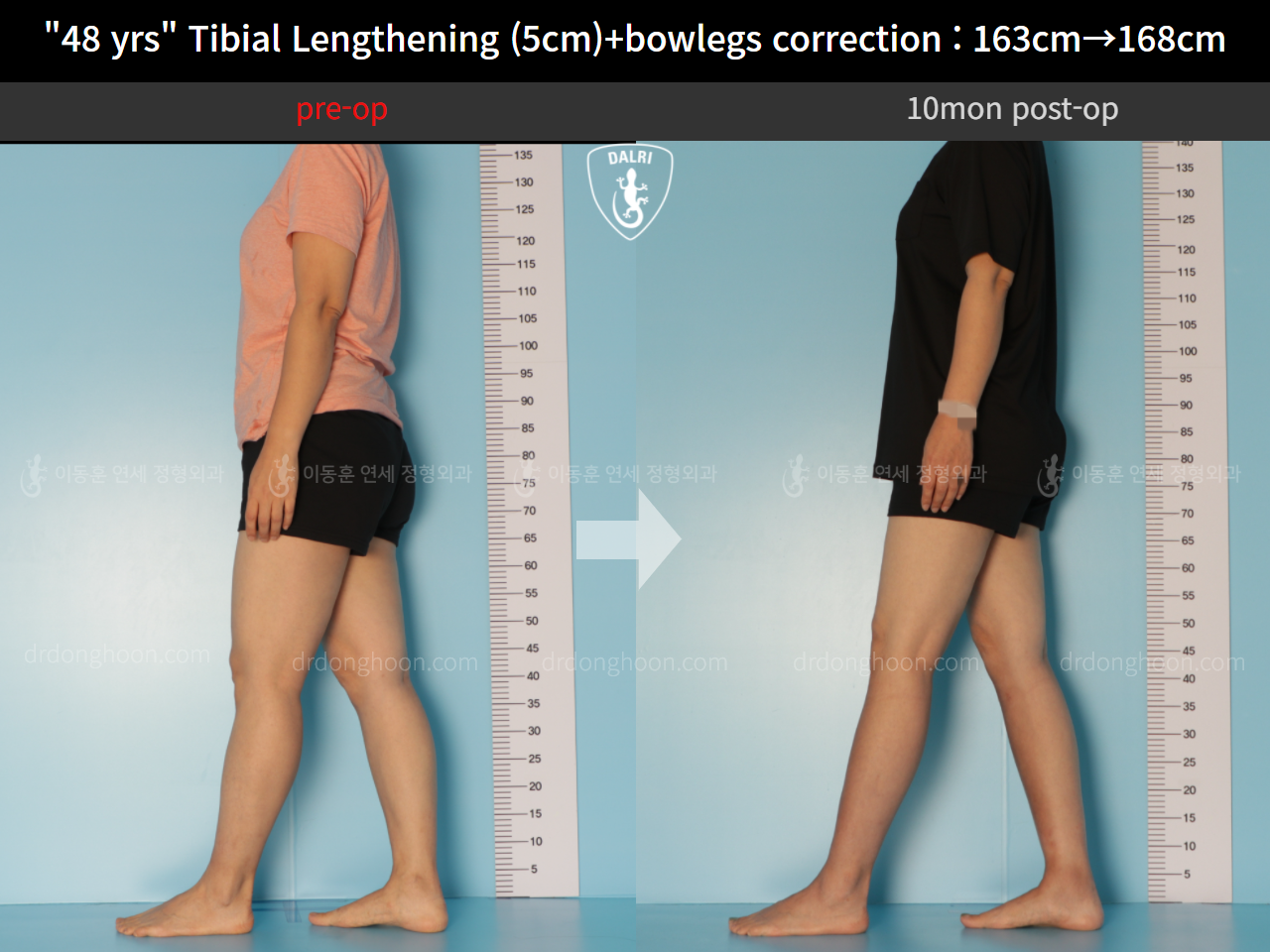 Before and after cll precice, case 10474341, image 4, Dr. Donghoon institute (DALRI)