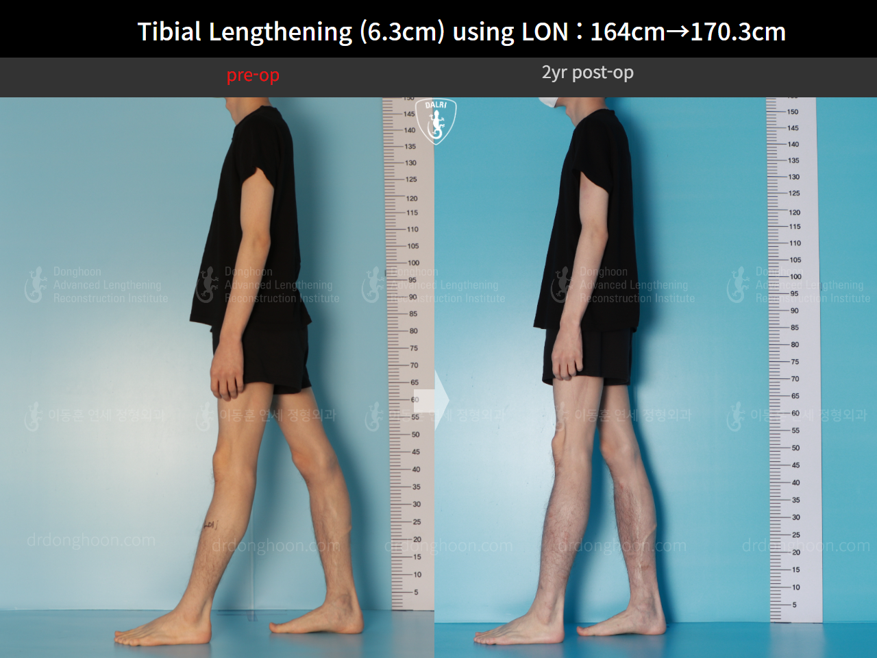 Before and after cll lon, case 16723608, image 7, Dr. Donghoon institute (DALRI)