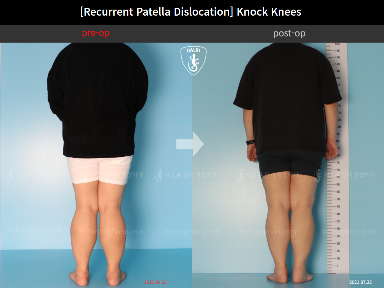 Before and after recurrent patella dislocation, case 10710327, image 4, Dr. Donghoon institute (DALRI)