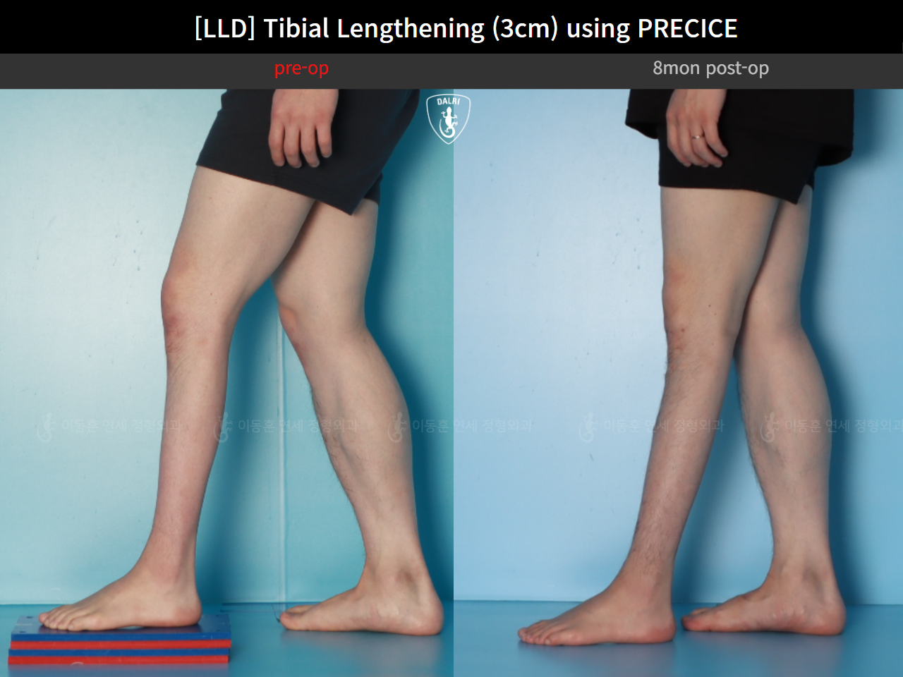 Before and after adult lld, case 124813877, image 7, Dr. Donghoon institute (DALRI)