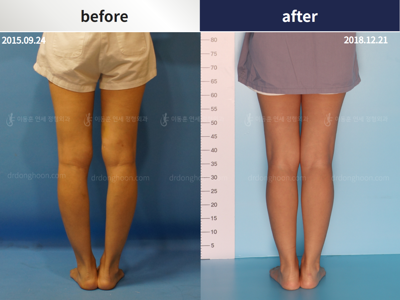 Before and after complex deformity, case 4251622, image 2, Dr. Donghoon institute (DALRI)