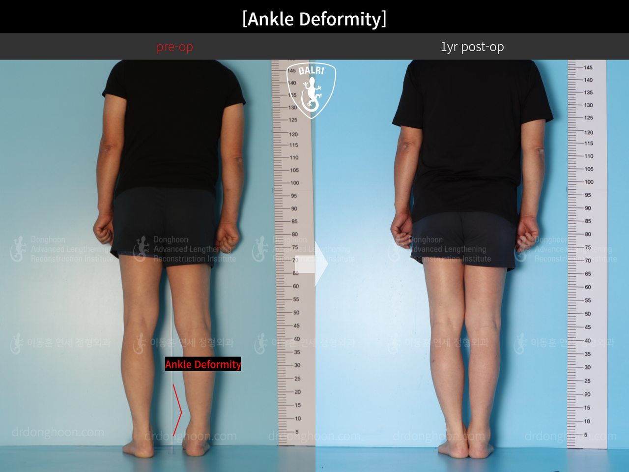 Before and after foot & ankle deformity, case 13580612, image 4, Dr. Donghoon institute (DALRI)