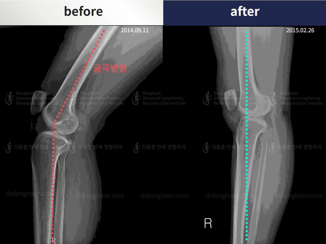 Before and after post-trauma deformity, case 4251782, image 3, Dr. Donghoon institute (DALRI)