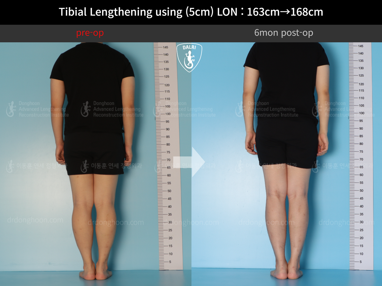 Before and after cll lon, case 12638628, image 2, Dr. Donghoon institute (DALRI)