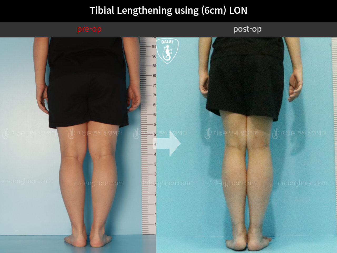 Before and after cll lon, case 11511553, image 4, Dr. Donghoon institute (DALRI)