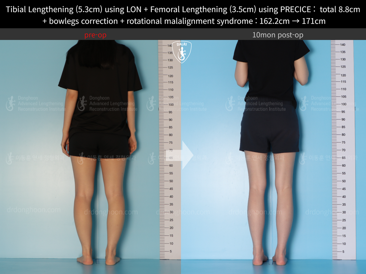 Before and after cll + deformity correction, case 13127167, image 5, Dr. Donghoon institute (DALRI)
