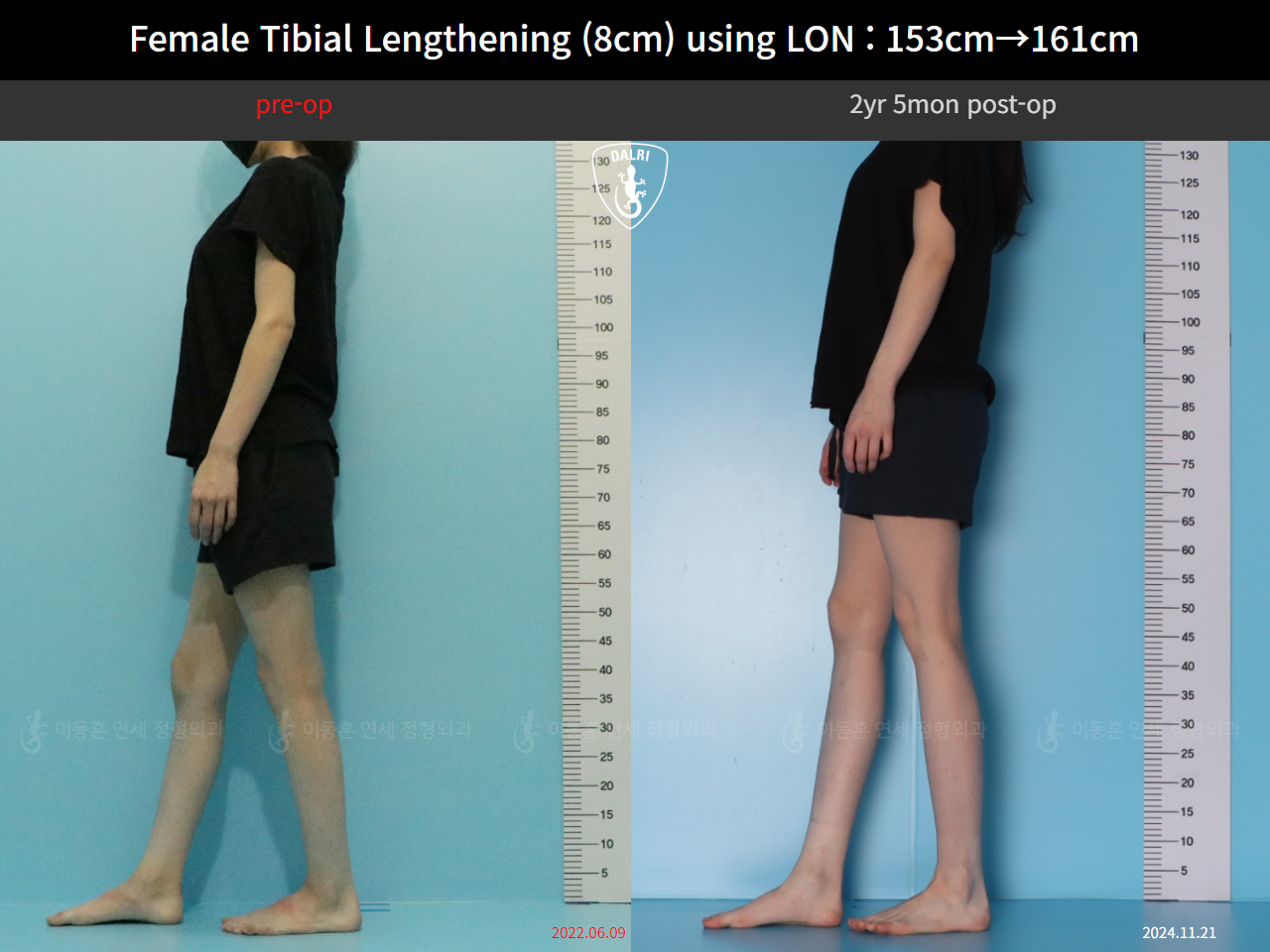 Before and after cll lon, case 128135191, image 7, Dr. Donghoon institute (DALRI)