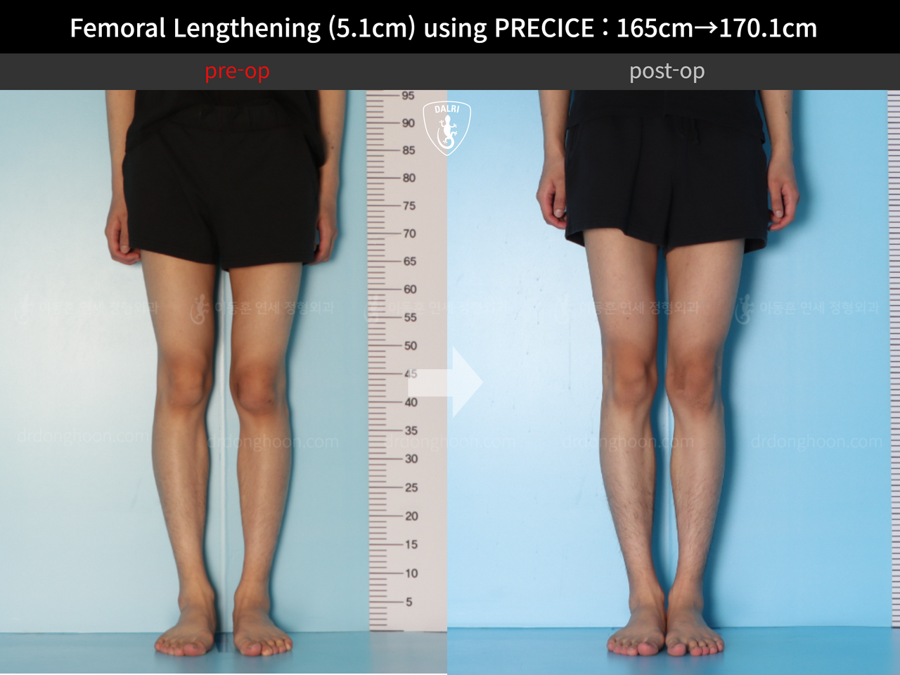 Before and after cll precice, case 13184743, image 5, Dr. Donghoon institute (DALRI)