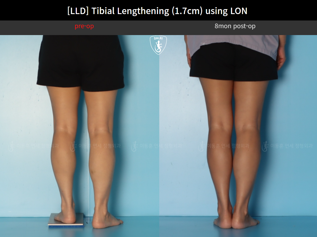 Before and after adult lld, case 126715948, image 6, Dr. Donghoon institute (DALRI)