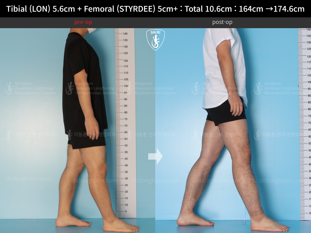 Before and after cll precice, case 13942494, image 9, Dr. Donghoon institute (DALRI)