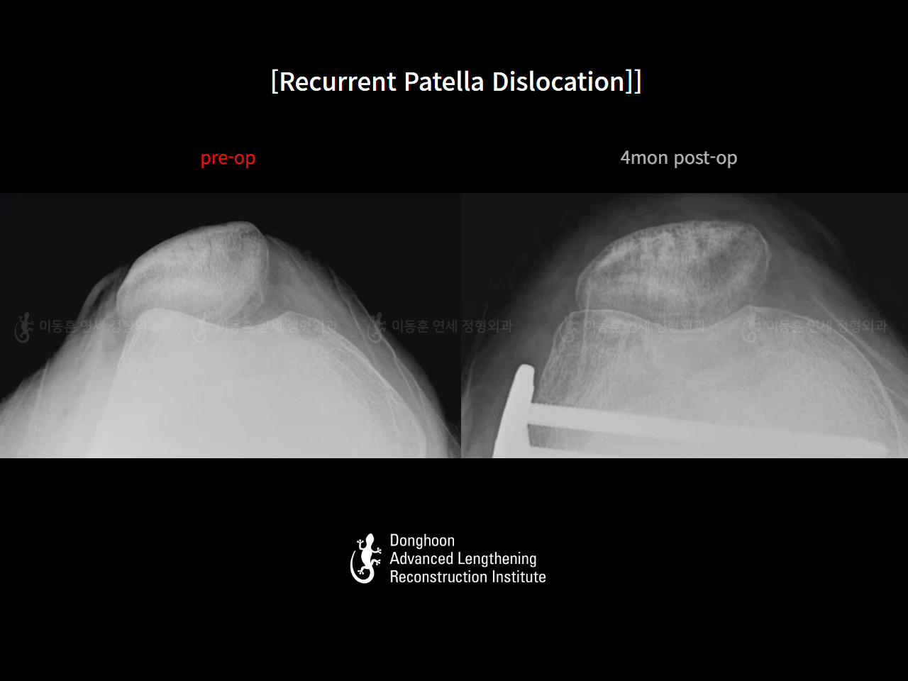 Before and after recurrent patella dislocation, case 125841847, image 11, Dr. Donghoon institute (DALRI)
