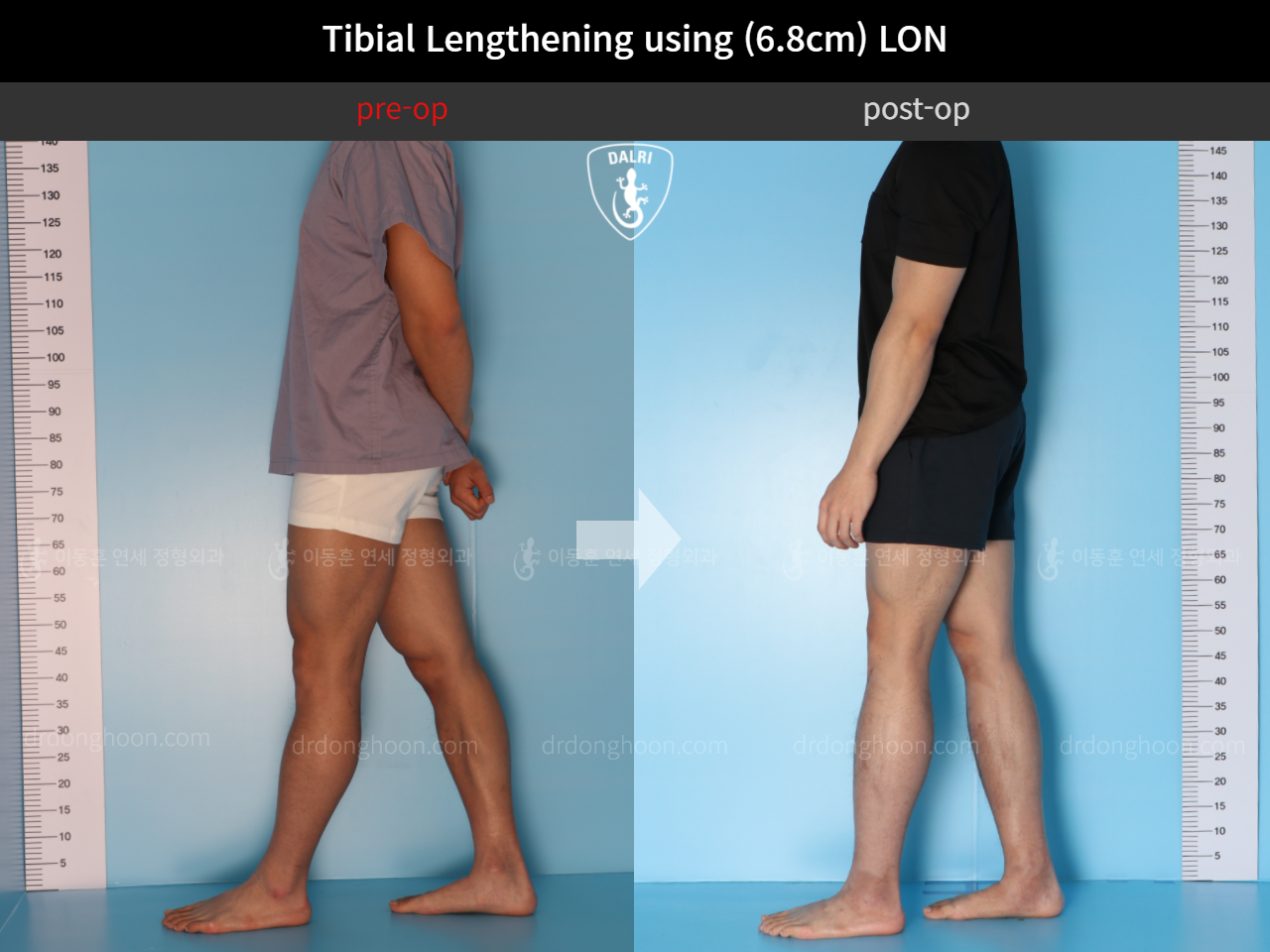Before and after cll lon, case 4577738, image 3, Dr. Donghoon institute (DALRI)