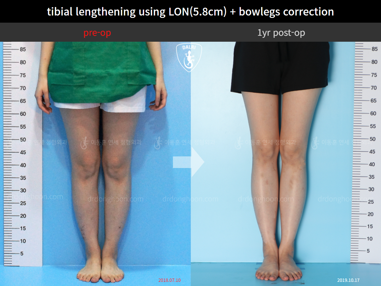 Before and after cll lon, case 4577846, image 5, Dr. Donghoon institute (DALRI)