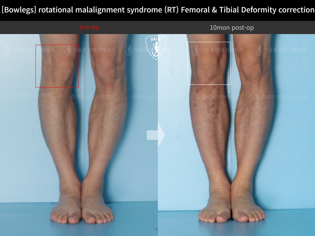 Before and after adult bowlegs, case 14220550, image 8, Dr. Donghoon institute (DALRI)