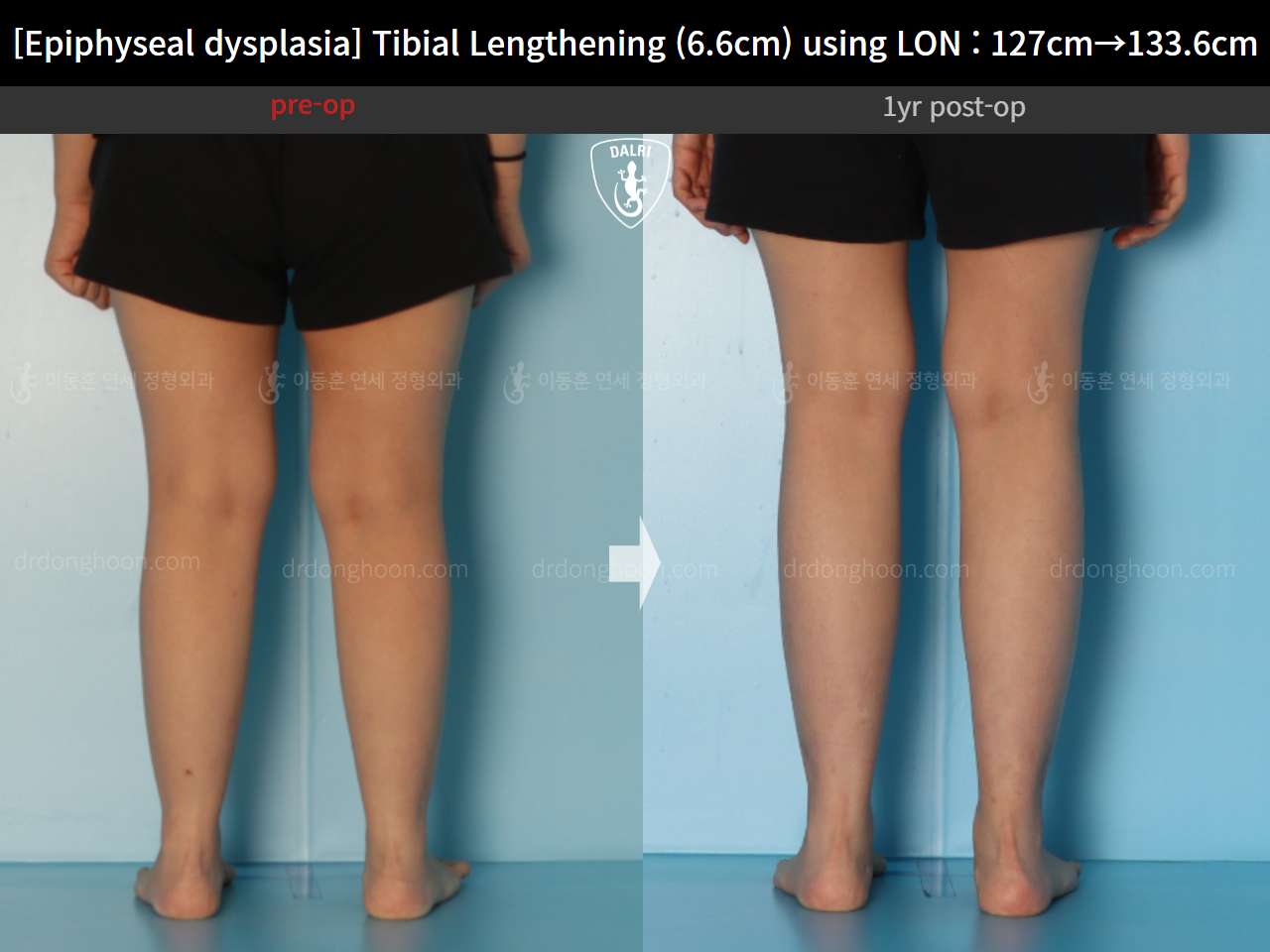 Before and after congenital condition, case 15072062, image 10, Dr. Donghoon institute (DALRI)
