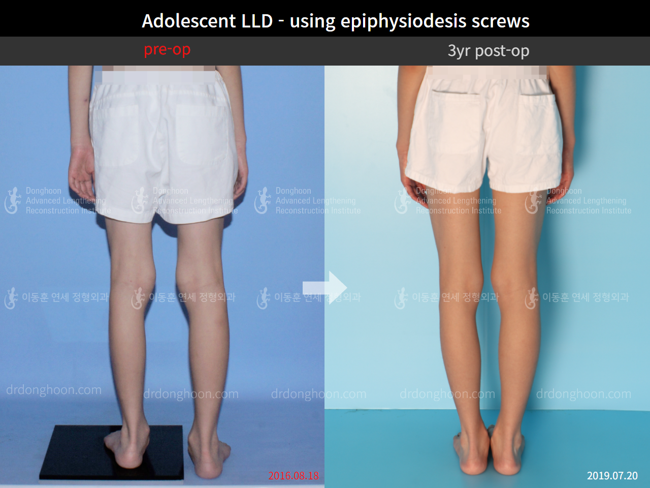 Before and after paediatric & adolescent lld, case 4320386, image 4, Dr. Donghoon institute (DALRI)