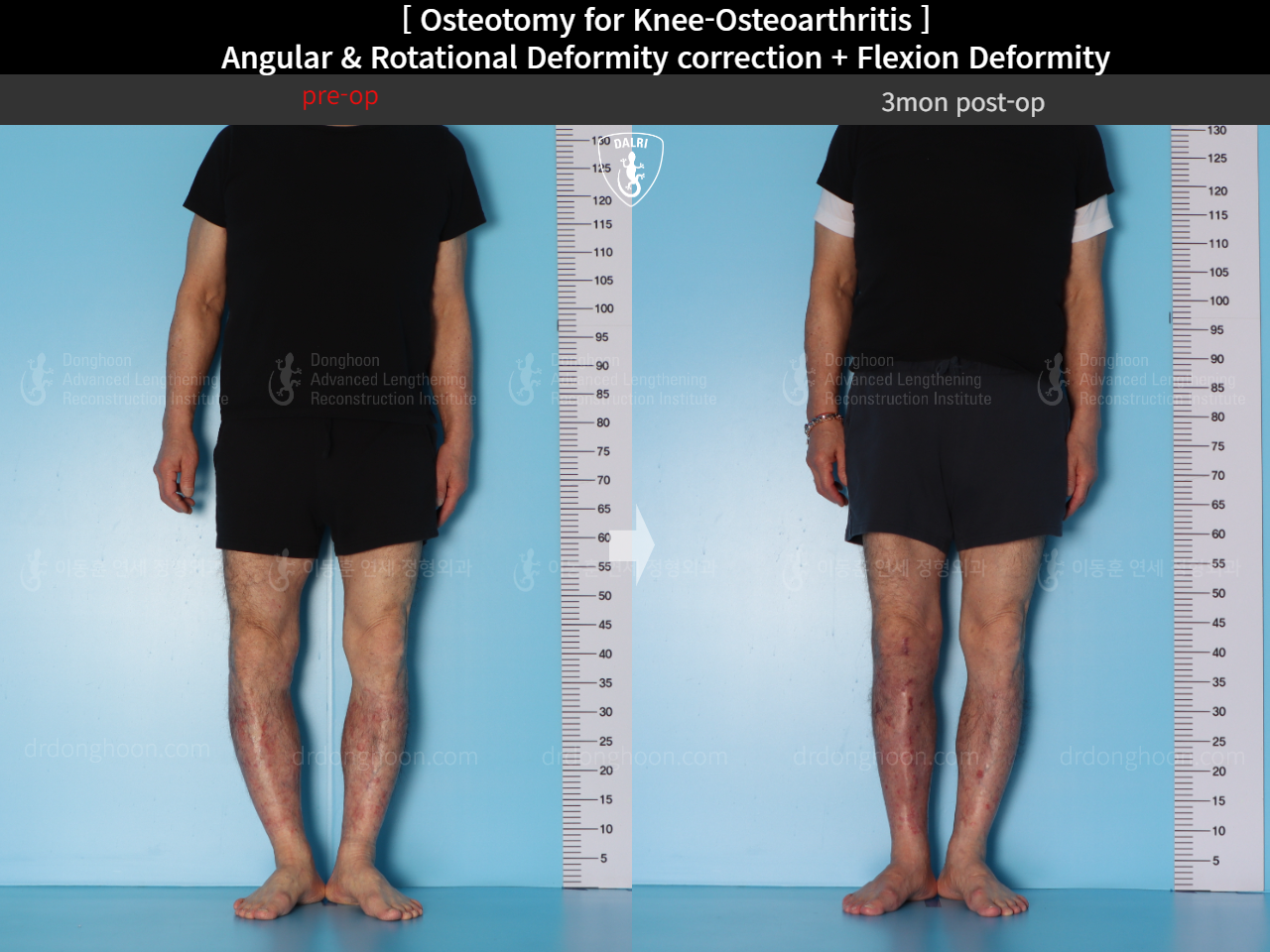 Before and after adult bowlegs, case 15362947, image 2, Dr. Donghoon institute (DALRI)