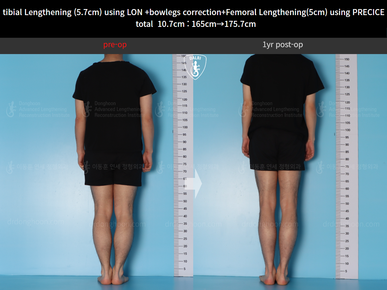 Before and after cll precice, case 20363375, image 2, Dr. Donghoon institute (DALRI)