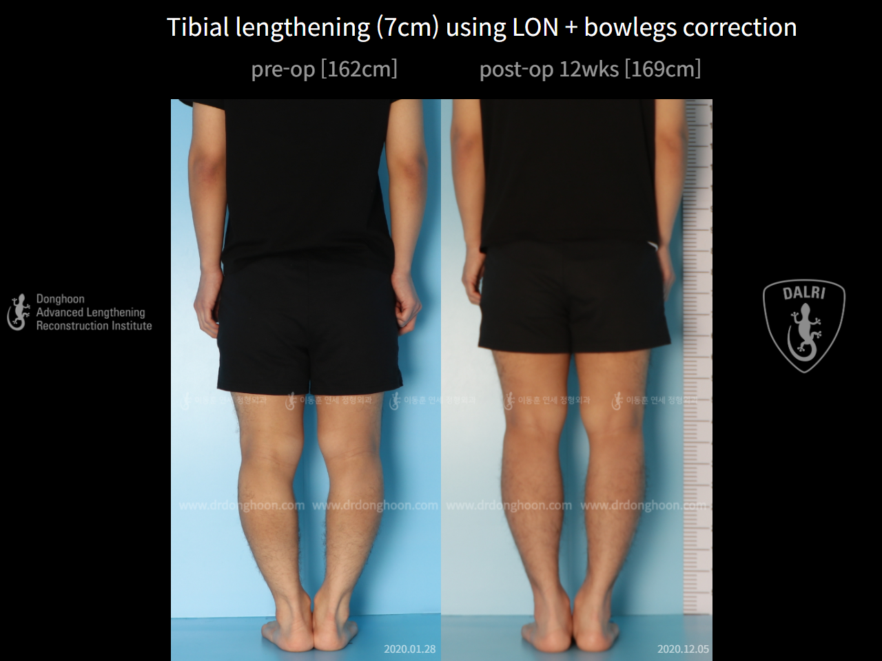 Before and after cll + deformity correction, case 6740433, image 5, Dr. Donghoon institute (DALRI)