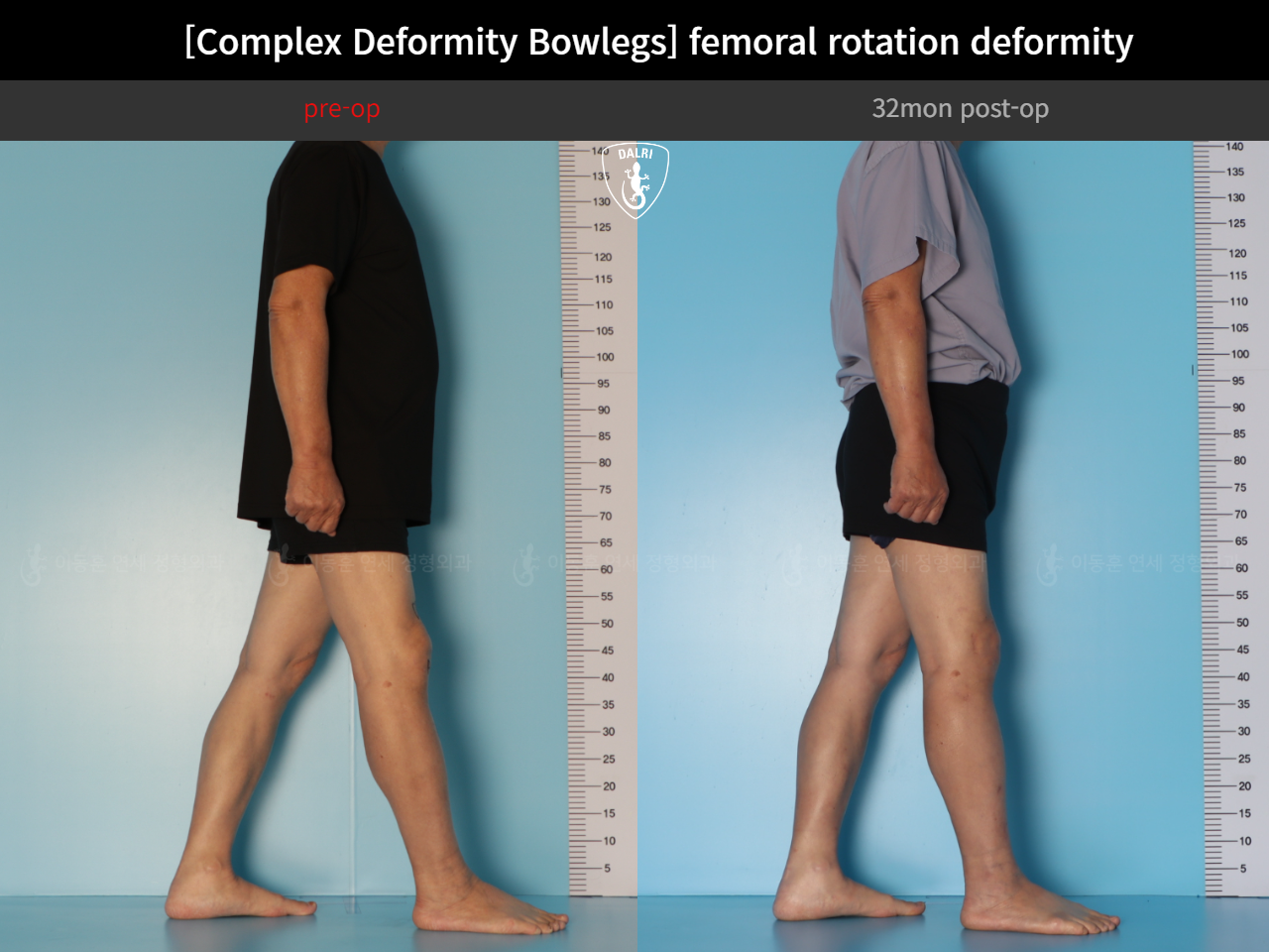 Before and after adult bowlegs, case 35242887, image 8, Dr. Donghoon institute (DALRI)