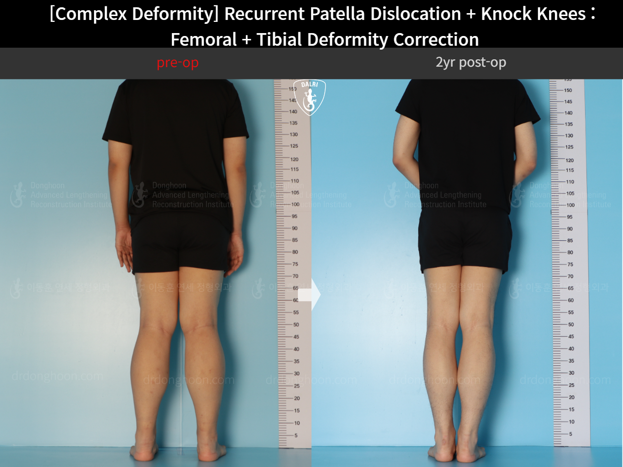 Before and after adult knock knees, case 17434917, image 2, Dr. Donghoon institute (DALRI)