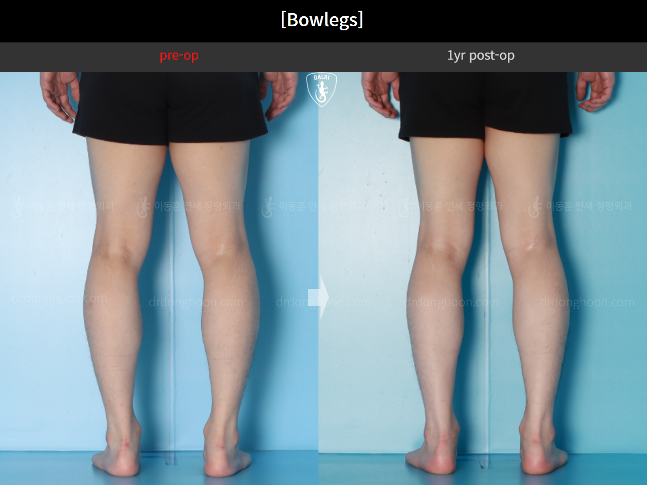 Before and after adult bowlegs, case 16724494, image 10, Dr. Donghoon institute (DALRI)