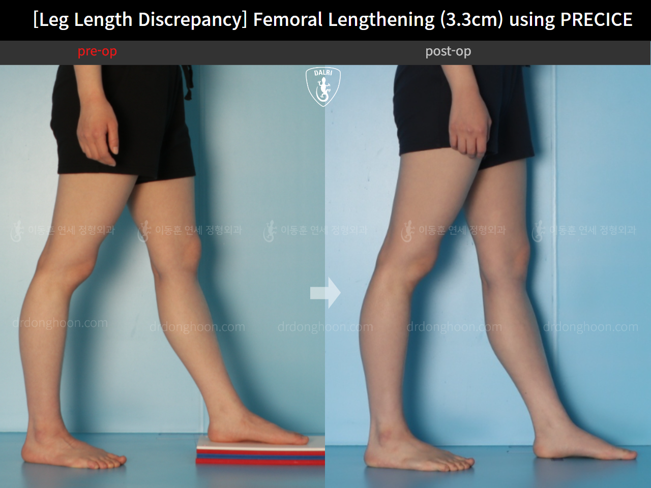Before and after adult lld, case 22355841, image 7, Dr. Donghoon institute (DALRI)