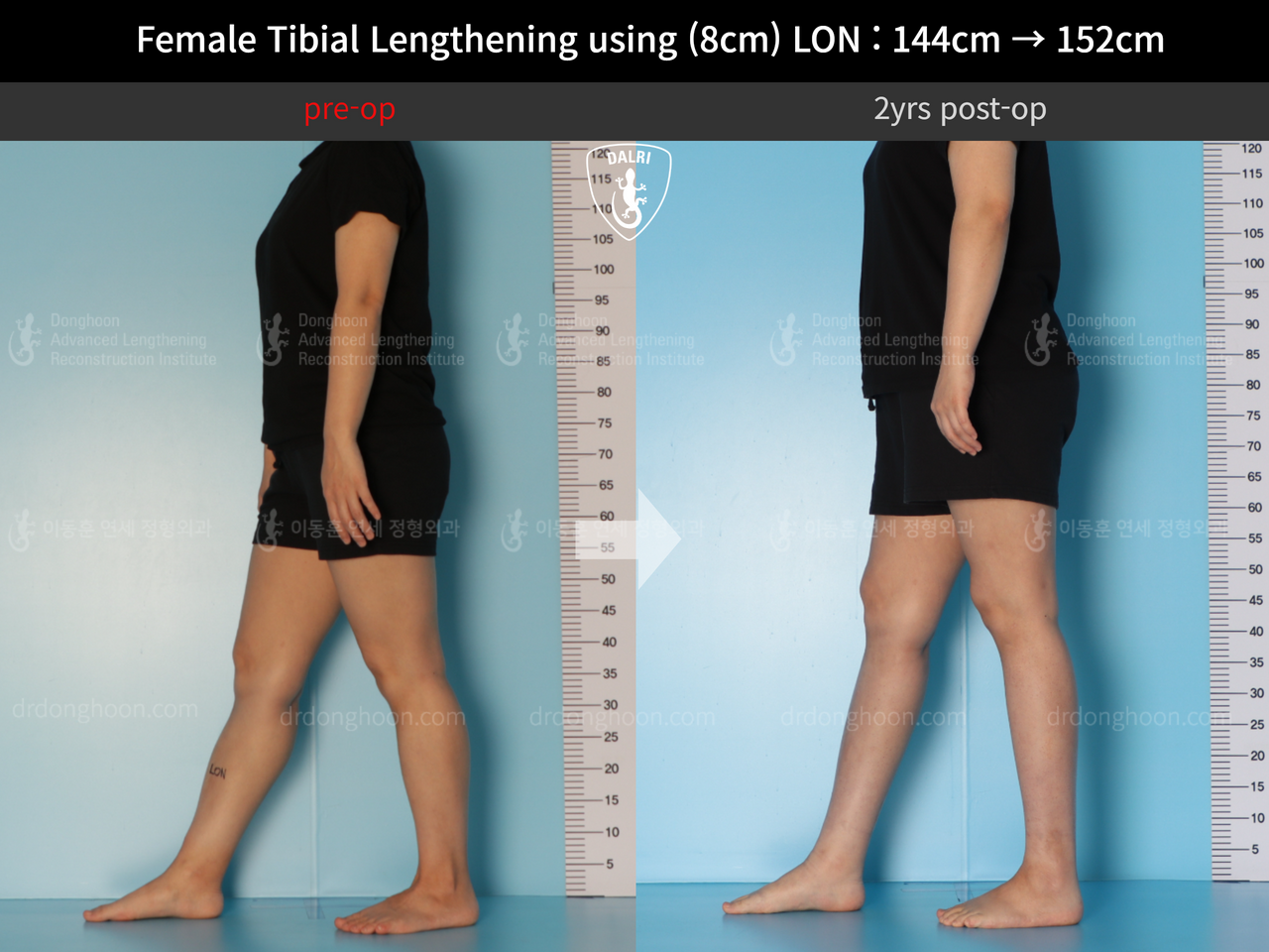 Before and after cll lon, case 12855676, image 6, Dr. Donghoon institute (DALRI)