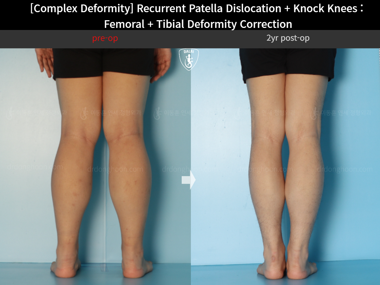 Before and after complex deformity, case 17435051, image 6, Dr. Donghoon institute (DALRI)