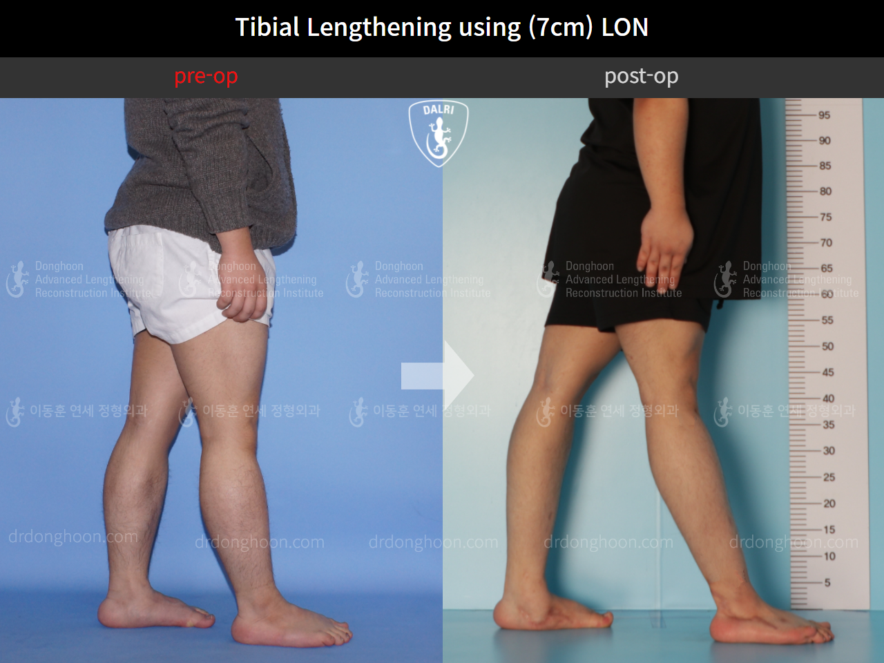 Before and after cll lon, case 10452499, image 6, Dr. Donghoon institute (DALRI)