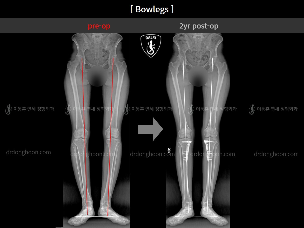 Before and after adult bowlegs, case 4311371, image 8, Dr. Donghoon institute (DALRI)