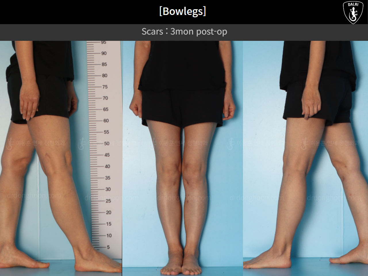 Before and after adult bowlegs, case 17463322, image 7, Dr. Donghoon institute (DALRI)