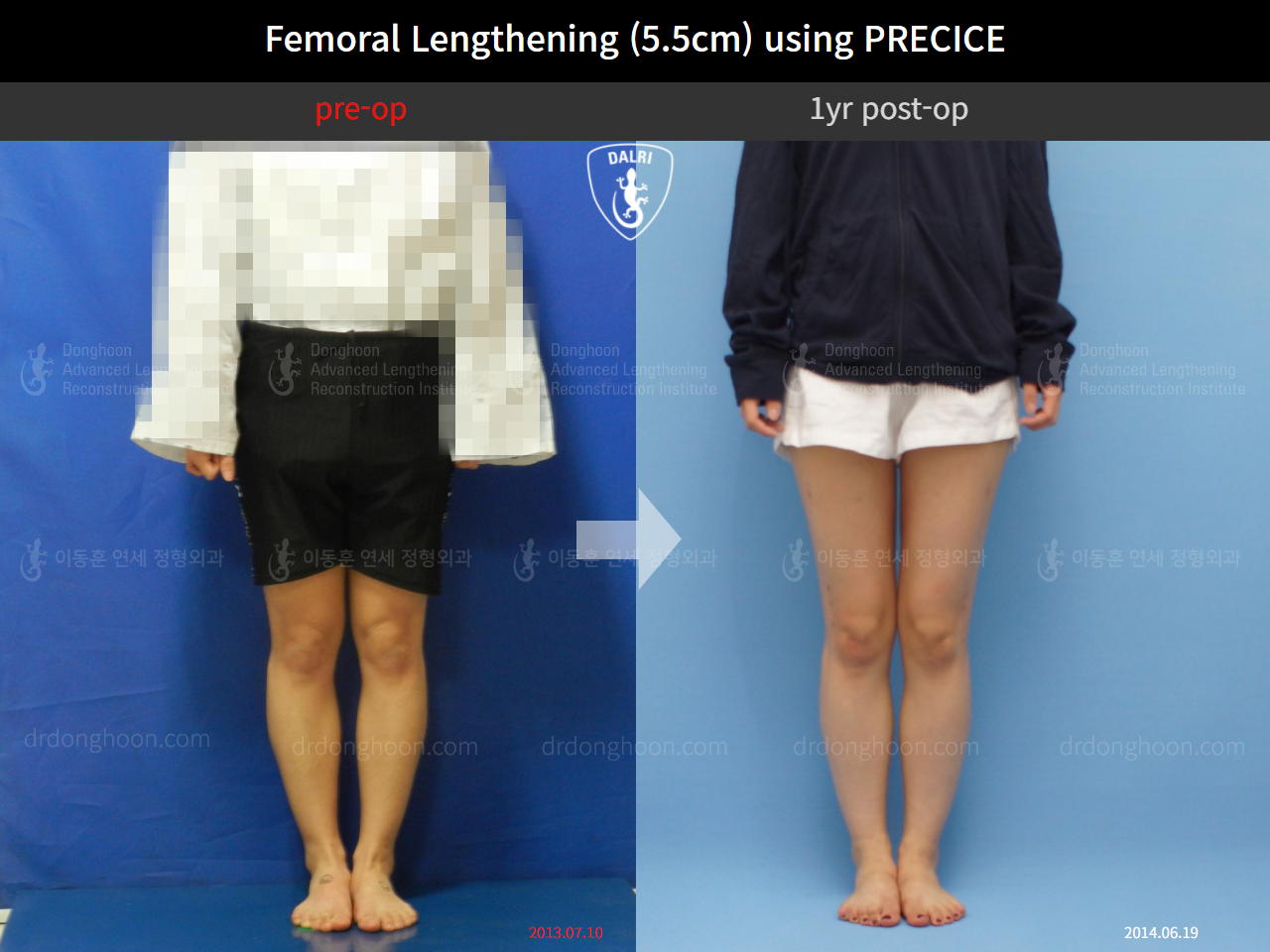 Before and after cll precice, case 4573623, image 1, Dr. Donghoon institute (DALRI)