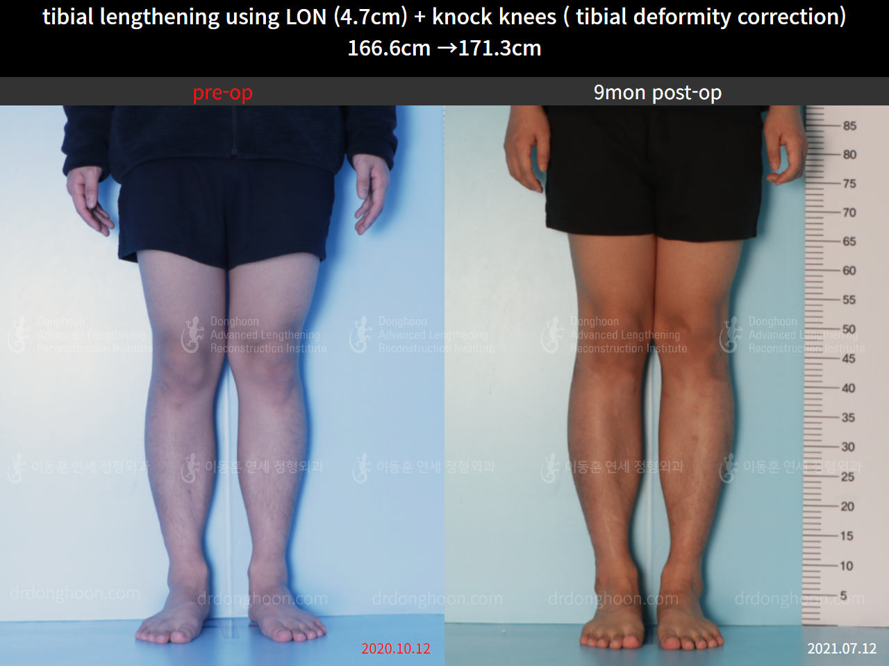 Before and after cll + deformity correction, case 8583829, image 5, Dr. Donghoon institute (DALRI)