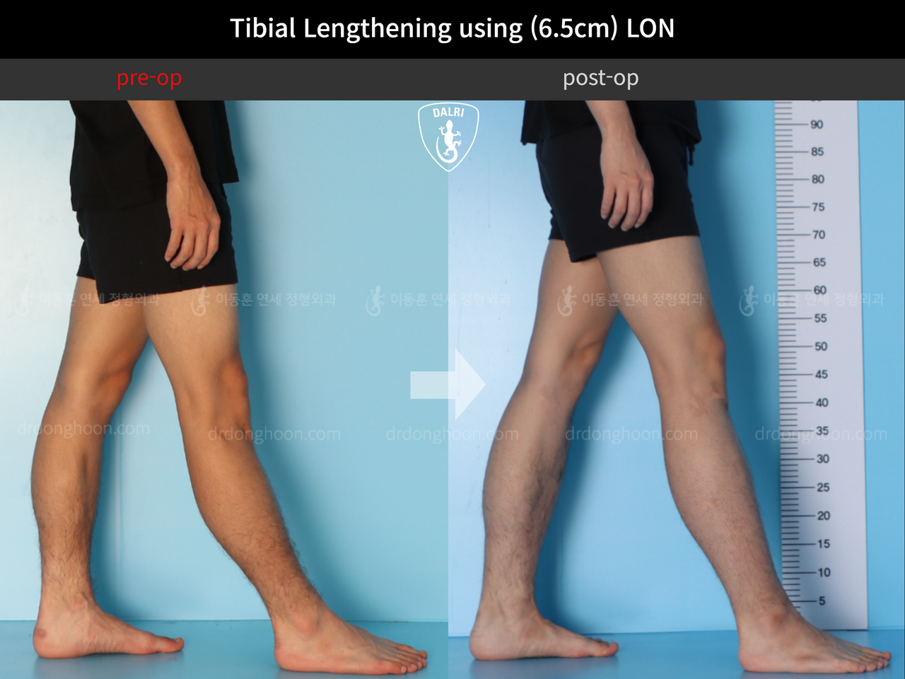 Before and after cll lon, case 12242145, image 6, Dr. Donghoon institute (DALRI)