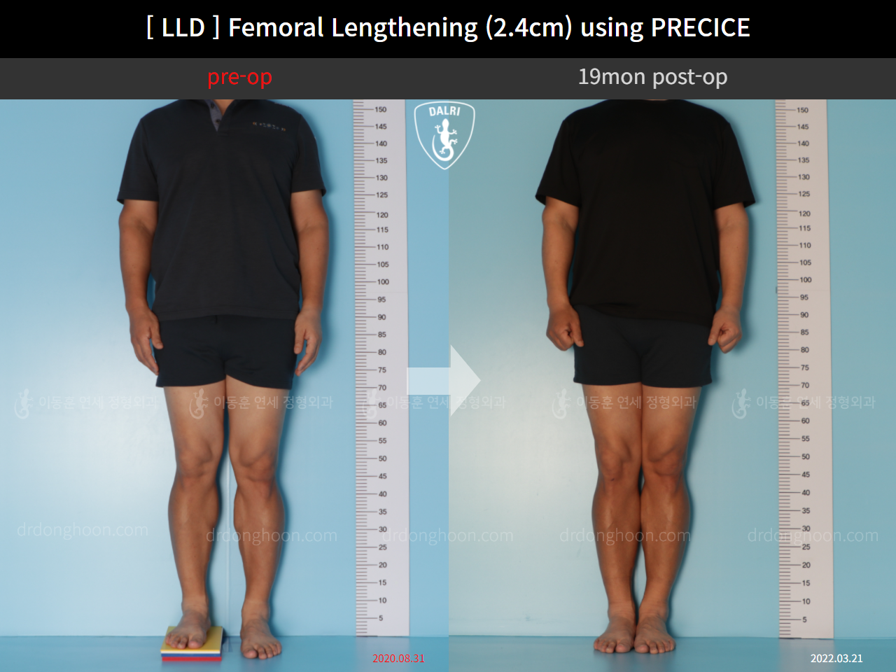 Before and after adult lld, case 10990486, image 1, Dr. Donghoon institute (DALRI)